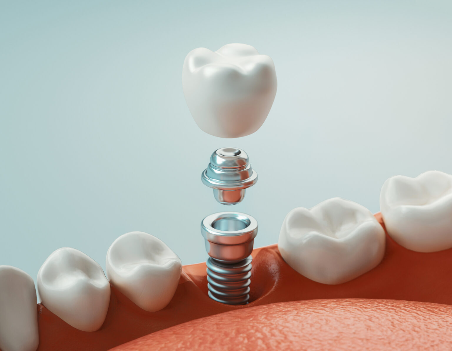 dental implants in gainesville