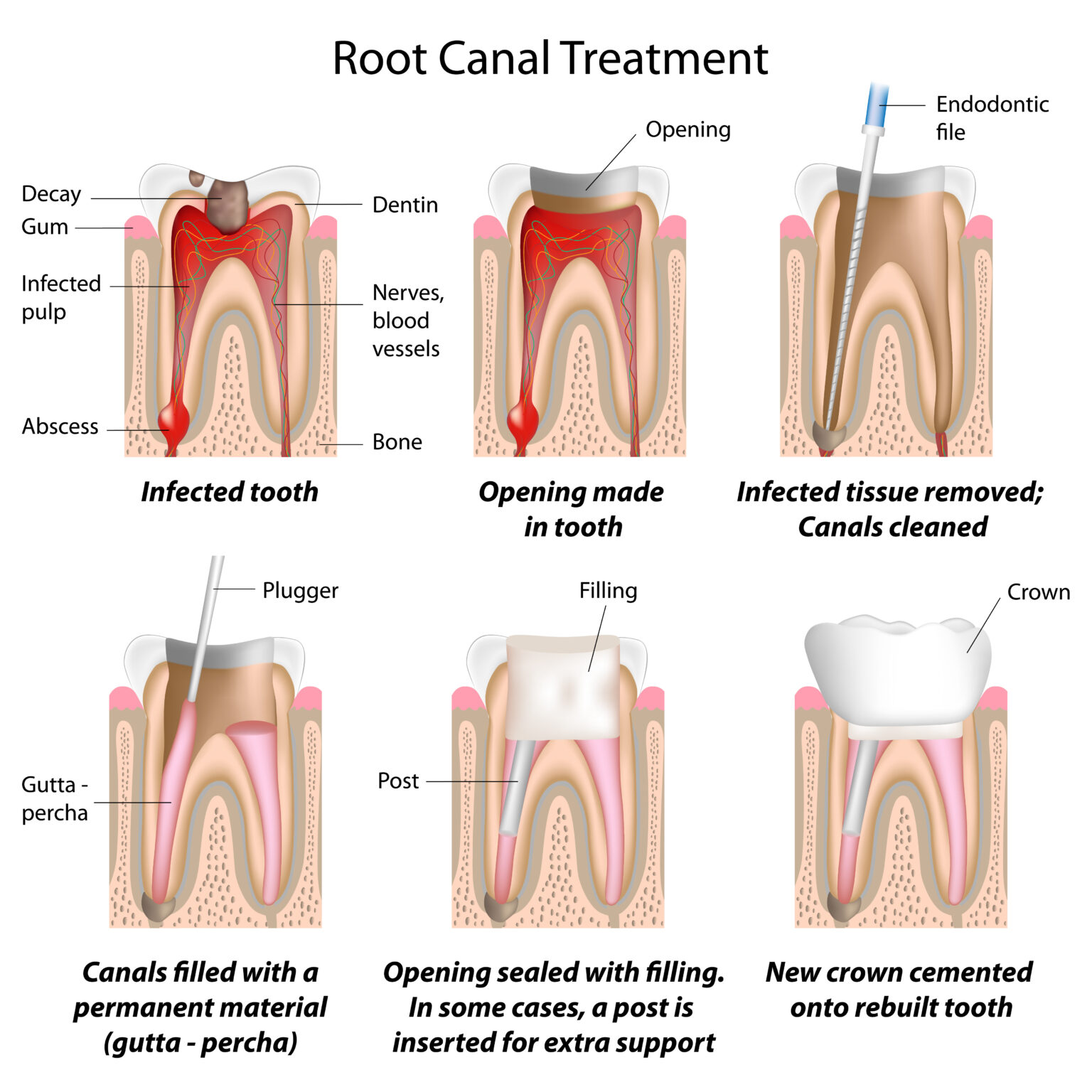 root canal therapy in gainesville
